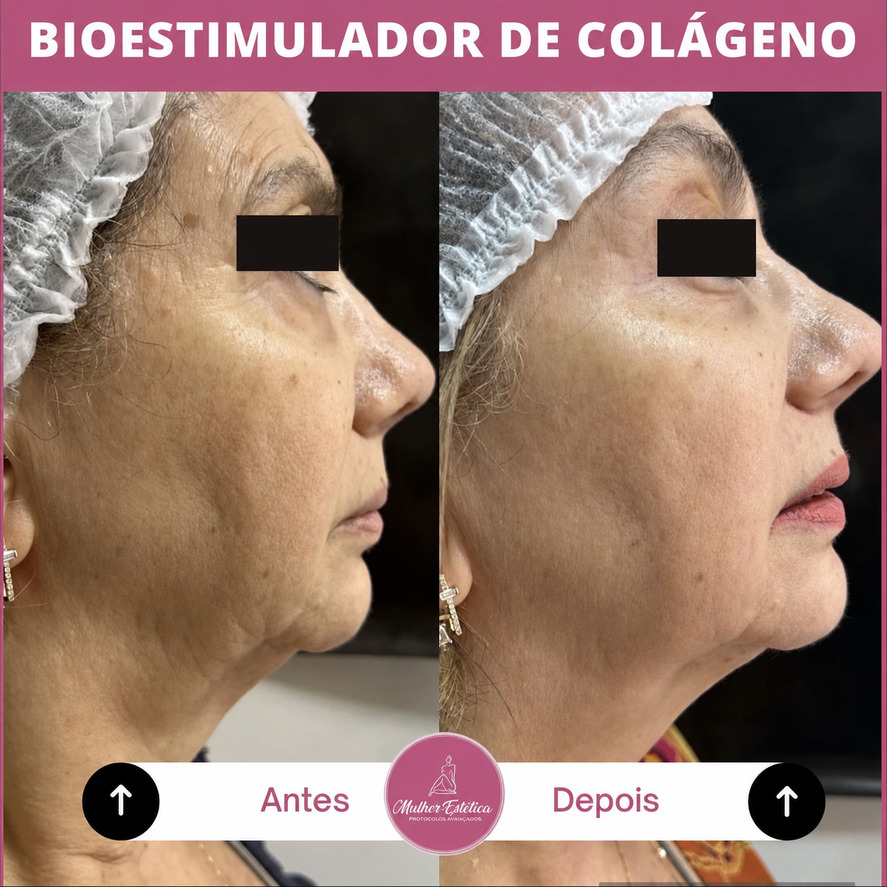 Bioestimuladores de colágeno utilizados em um planejamento estético personalizado