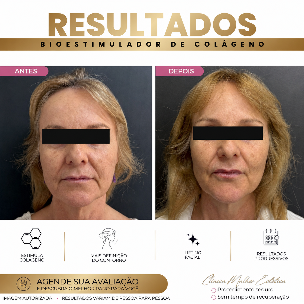 Aplicação de bioestimulador de colágeno para estímulo da firmeza da pele