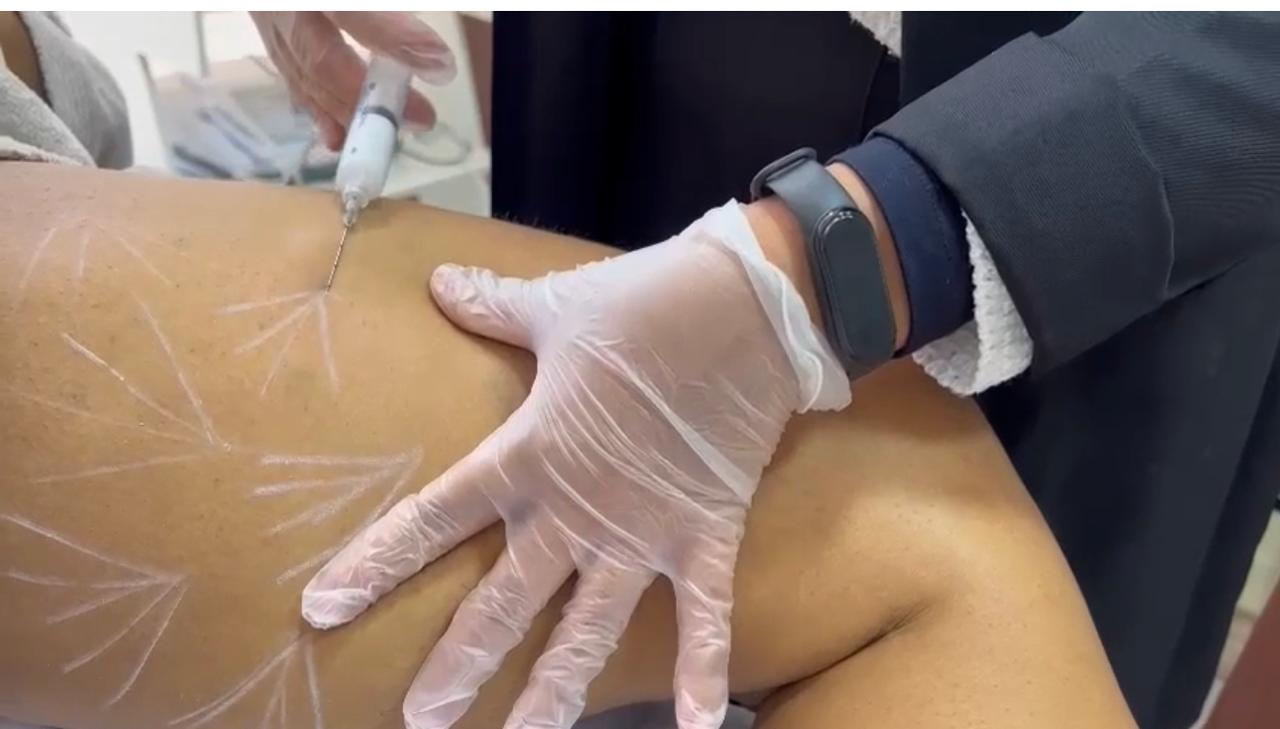 Aplicação de bioestimulador de colágeno corporal em pontos estratégicos