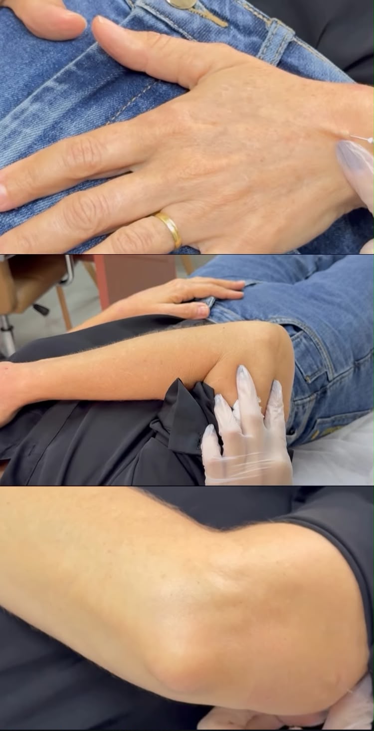 Etapas da aplicação de bioestimulador corporal em diferentes regiões