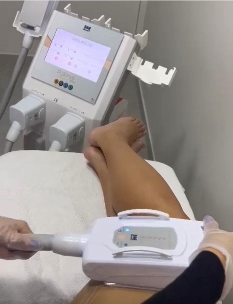 Aplicação da Crio Dinâmica em tratamento corporal