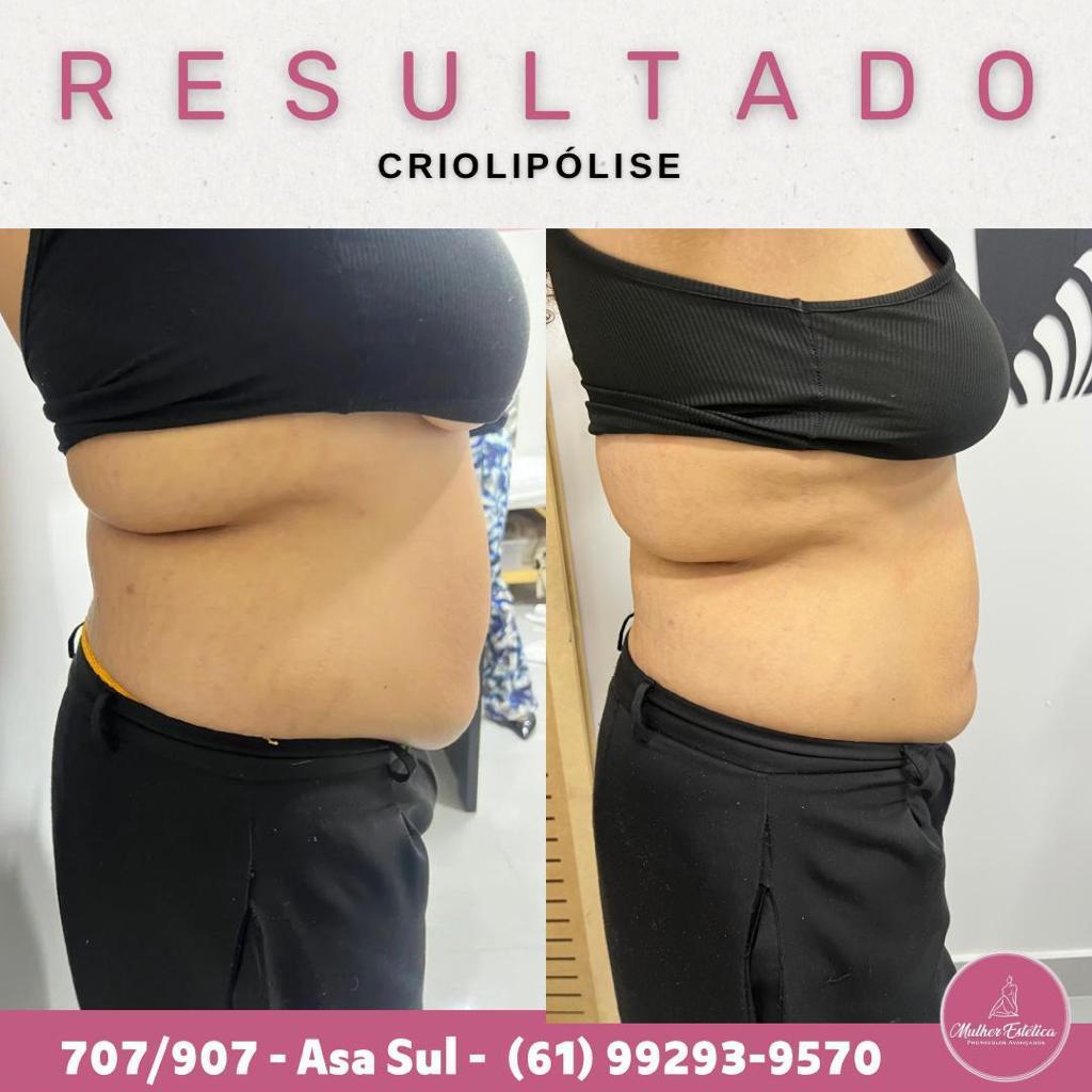 Resultado antes e depois de criolipólise de placas para gordura localizada
