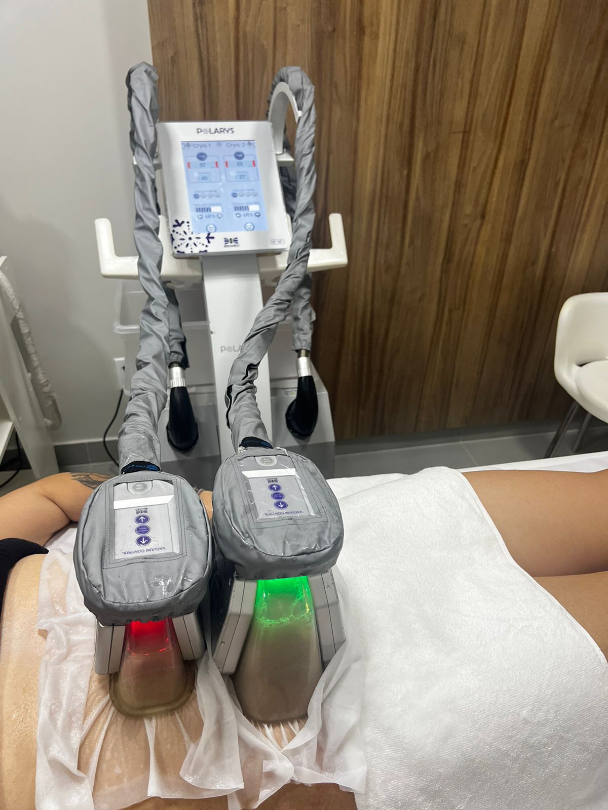 Aplicação de Criolipólise de Placas Polarys Plaxx em tratamento corporal