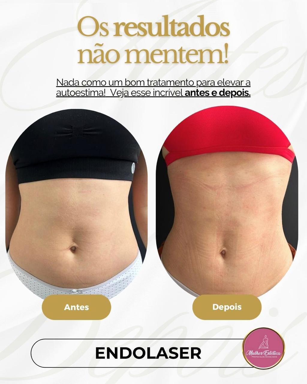 Equipamento de Endolaser Corporal Elyon para flacidez e remodelação corporal