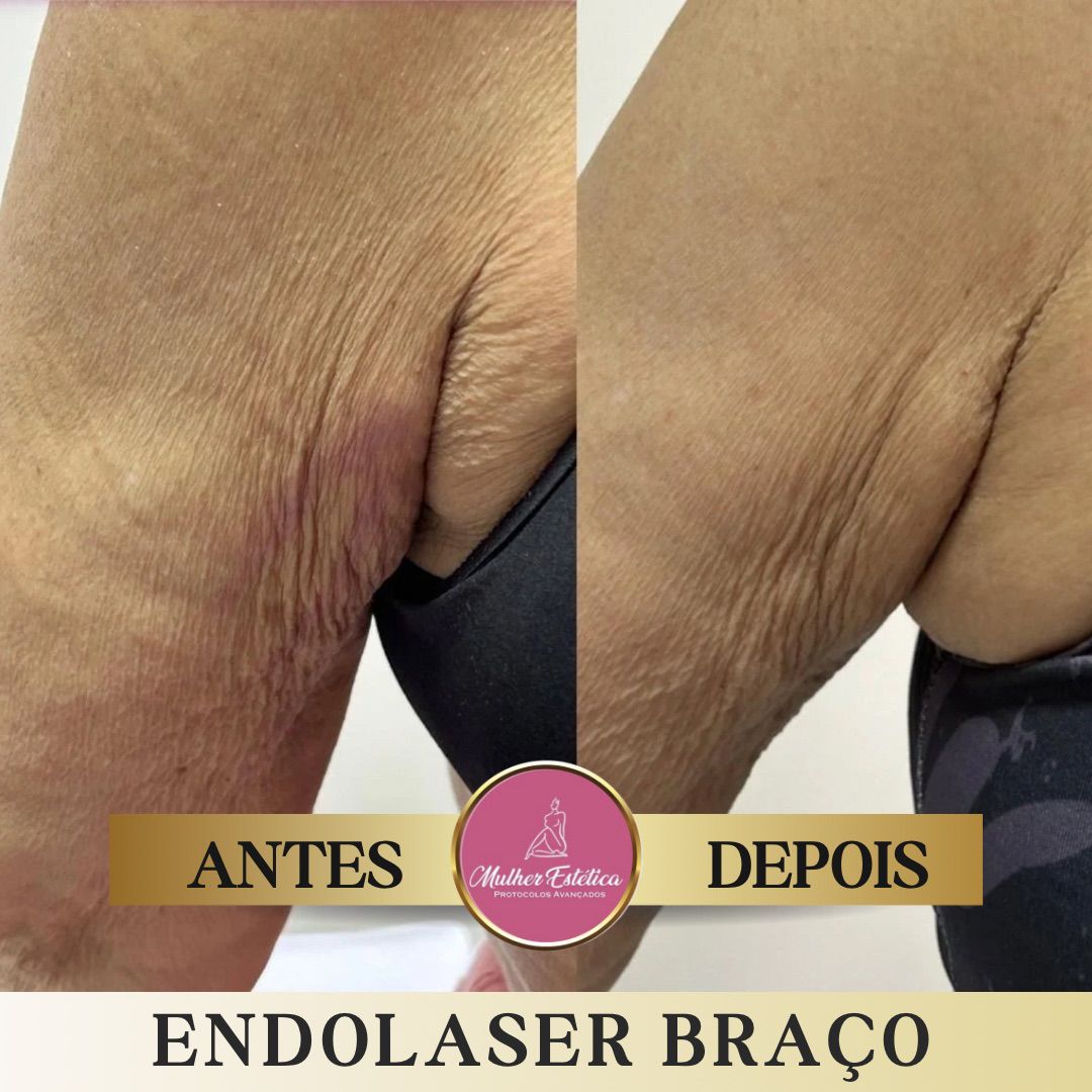 Aplicação de Endolaser Corporal Elyon com microfibra óptica