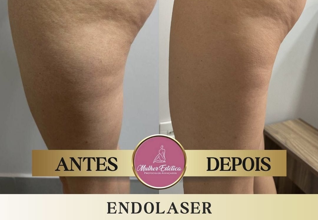 Resultado corporal após tratamento com Endolaser Elyon