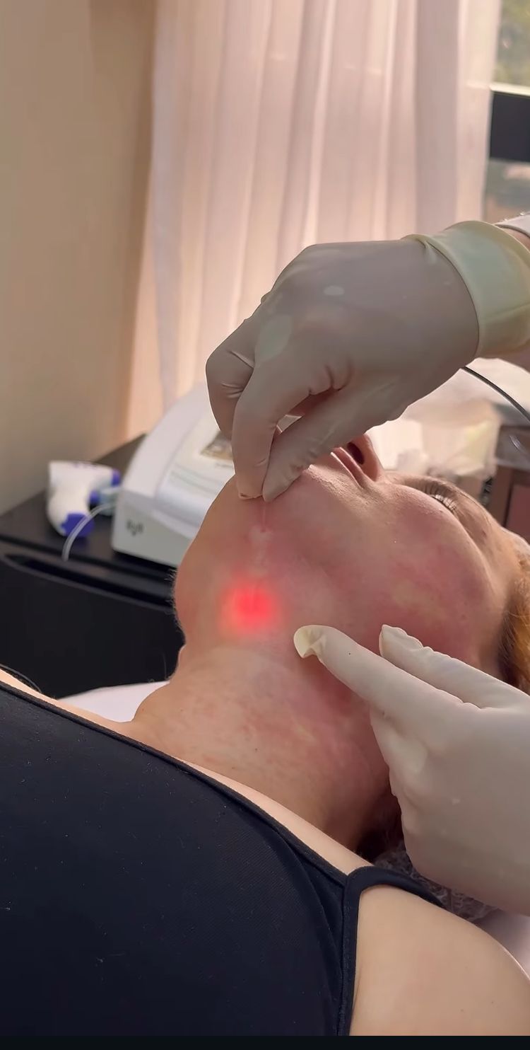 Resultado ilustrativo do Endolaser Facial para firmeza e definição do contorno