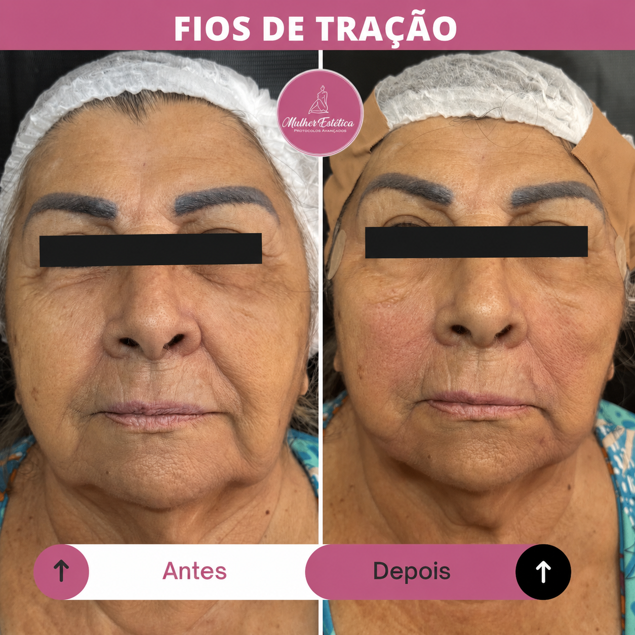 Fios de tração de PDO para lifting e reposicionamento dos tecidos