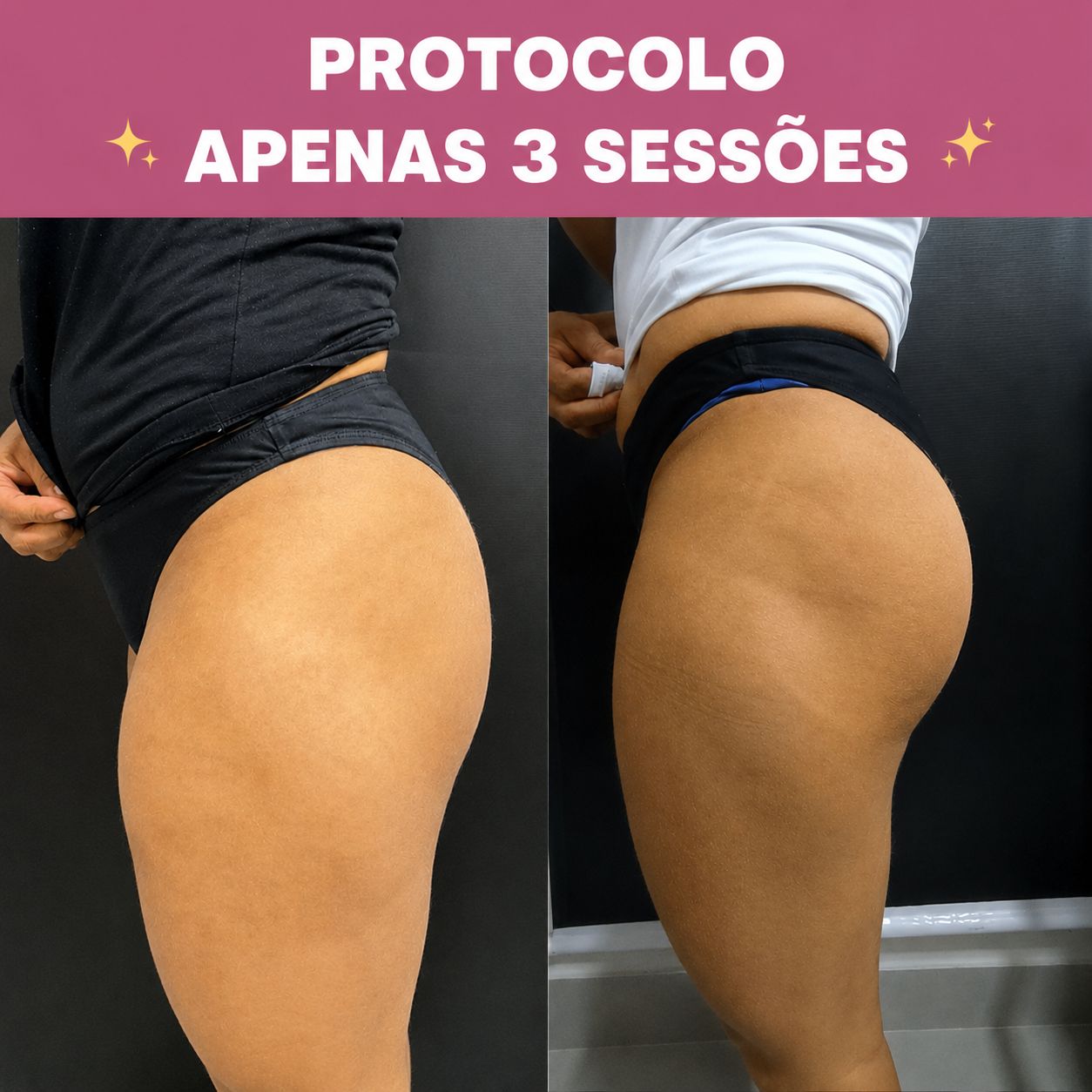 Sessão personalizada de Pump Glúteo na Clínica Mulher Estética