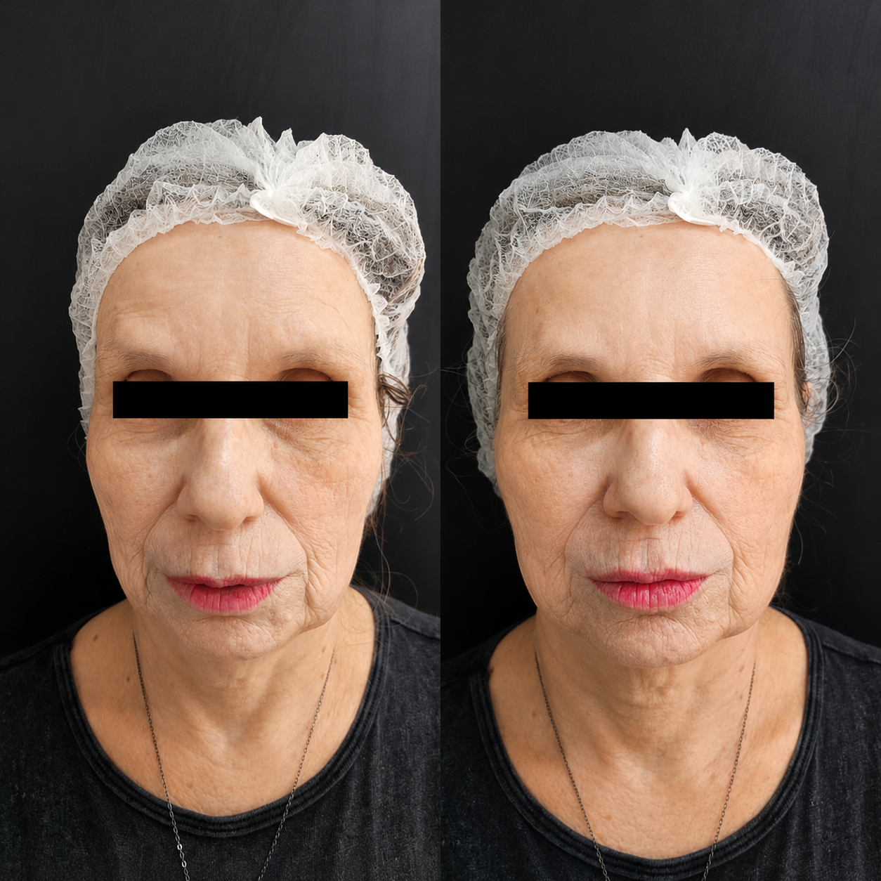 Harmonização facial para equilíbrio, contorno e rejuvenescimento natural