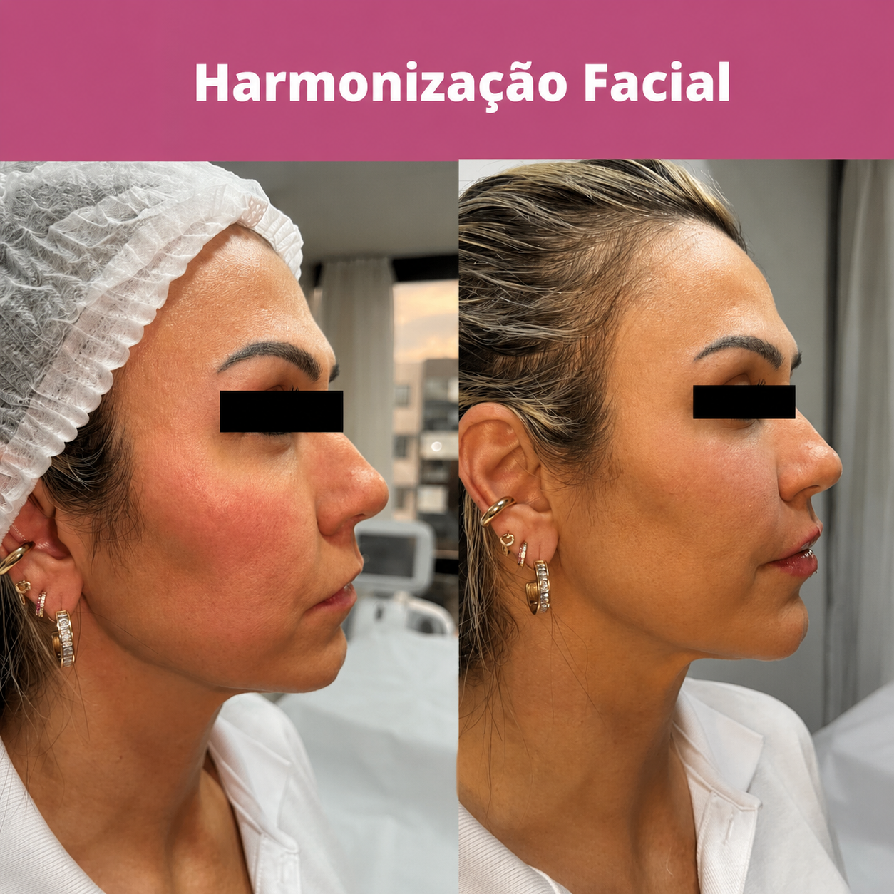 Avaliação e planejamento personalizado para harmonização facial natural