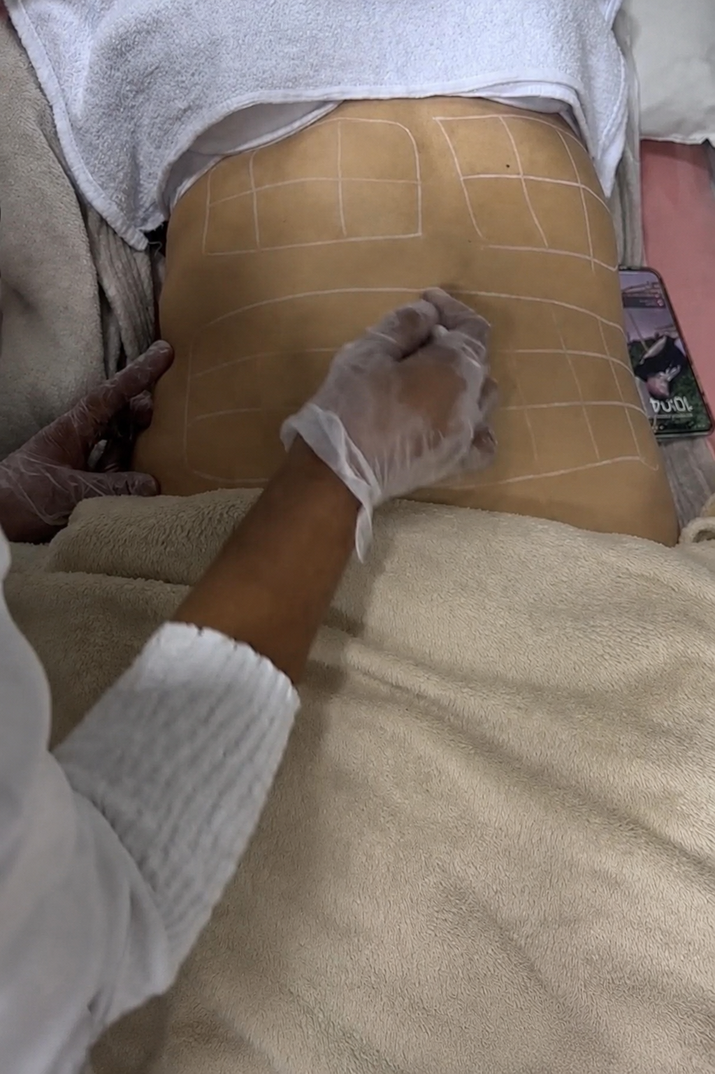 Aplicação de Hidrolipoclasia associada ao ultrassom estético corporal