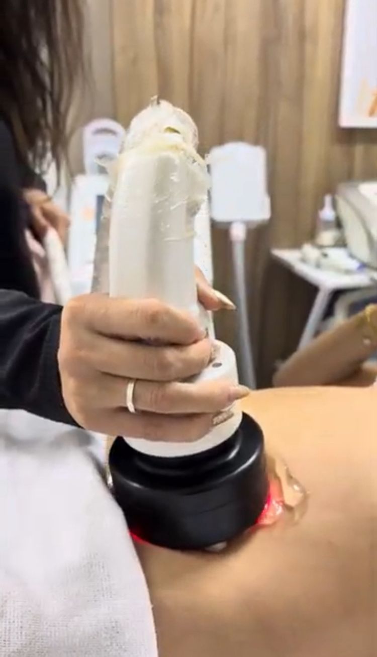 Aplicação do Hybrius com radiofrequência, ultracavitação e LipoLED