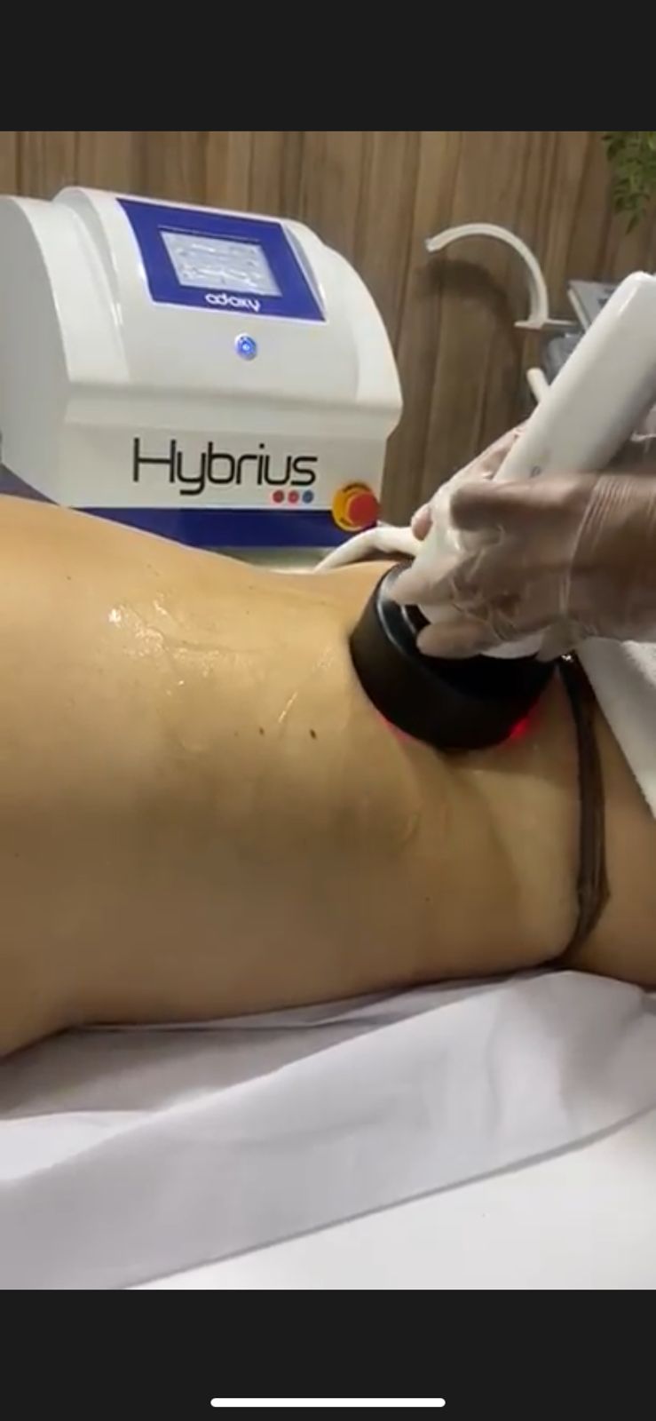 Resultado de tratamento corporal com Hybrius para firmeza e contorno corporal