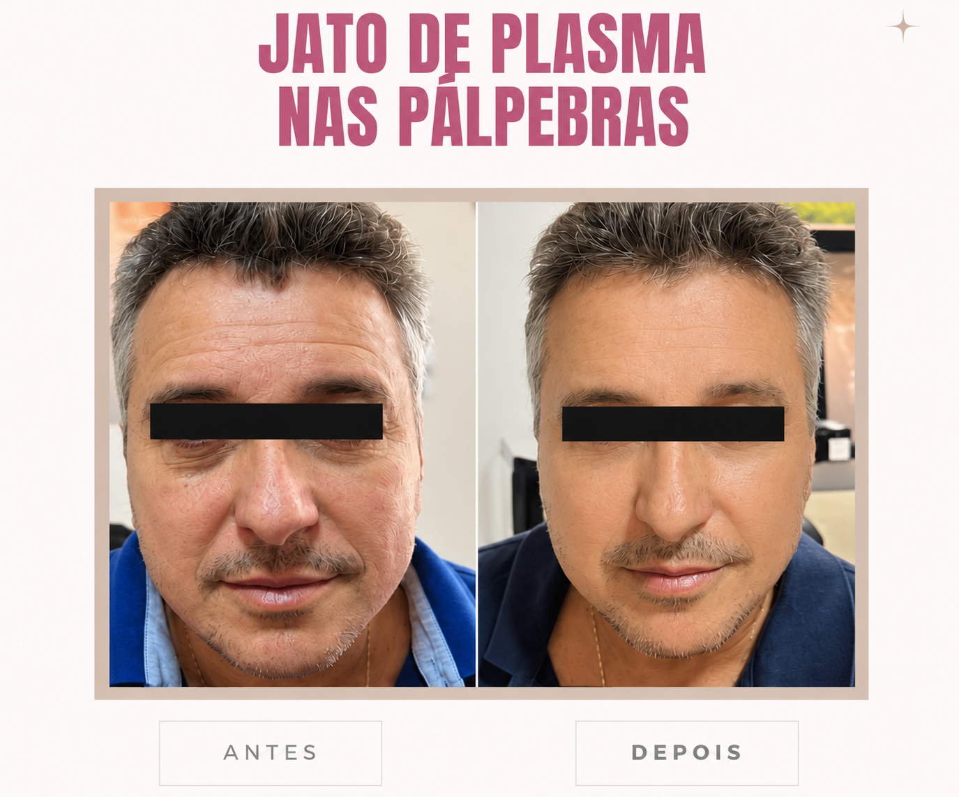 Antes e depois do tratamento com Jato de Plasma nas pálpebras