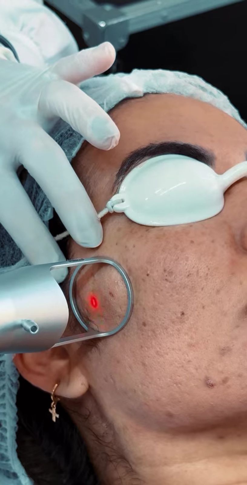 Aplicação do Laser de CO2 Fracionado para renovação e rejuvenescimento da pele