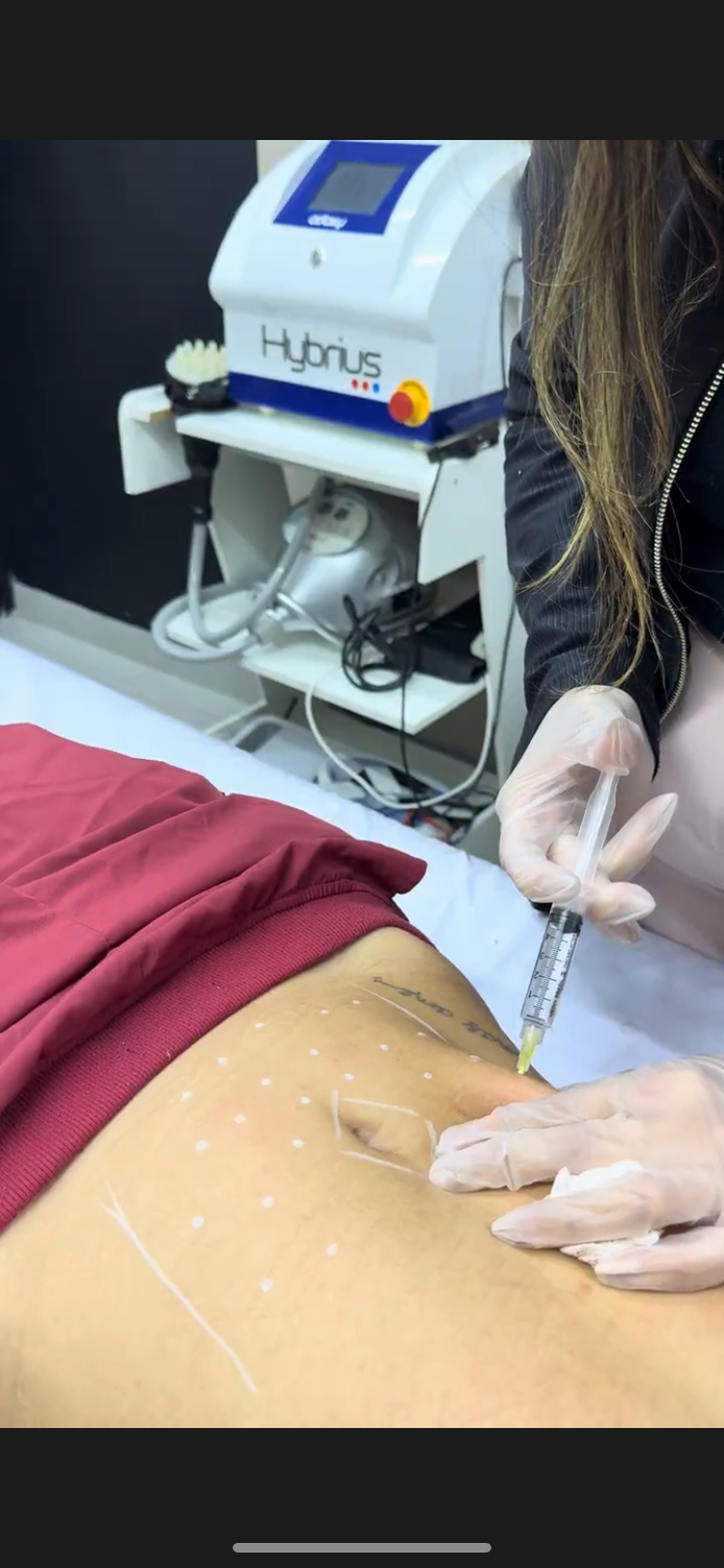 Lipo Enzimática para redução de gordura localizada