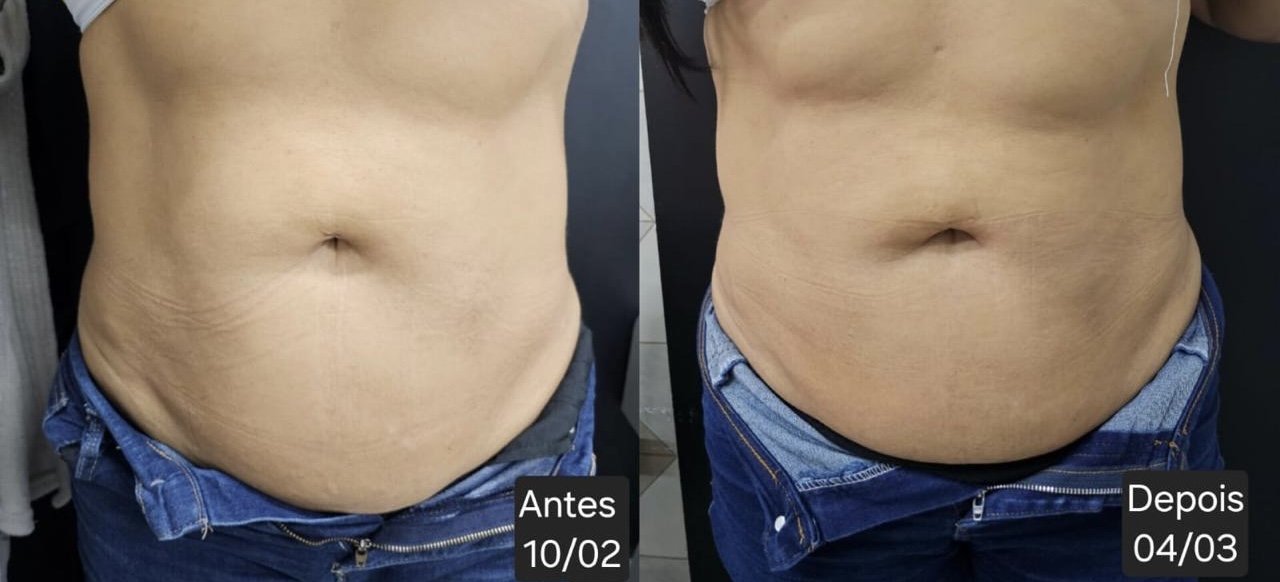 Aplicação da Lipo Enzimática