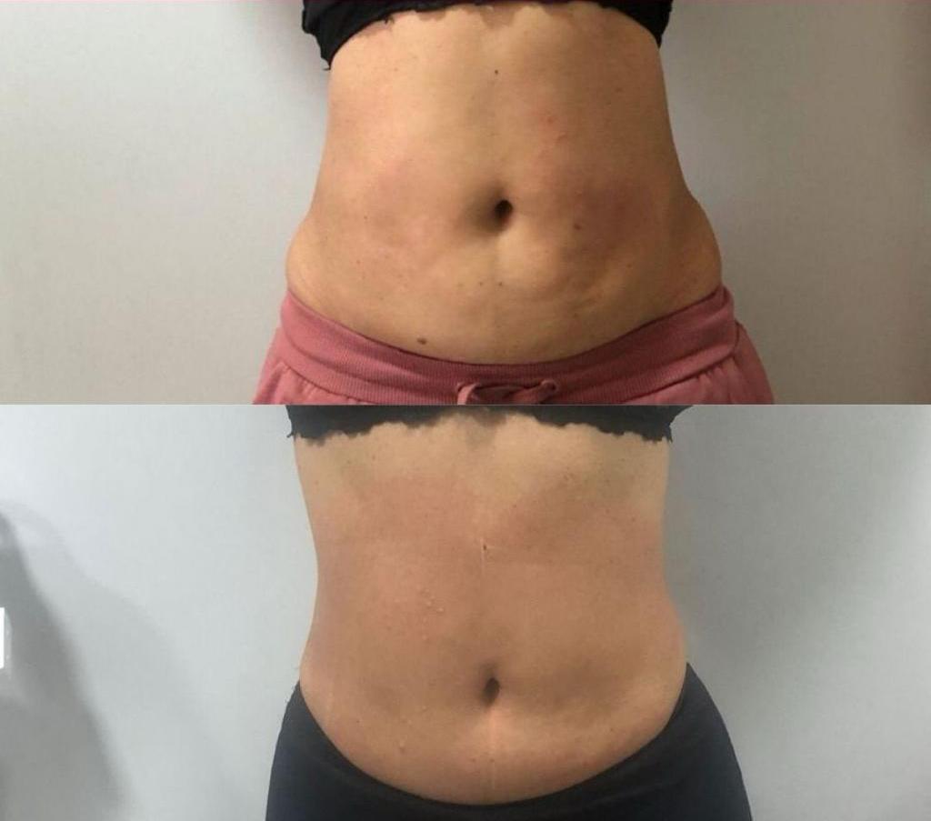 Sessão de Lipo Enzimática