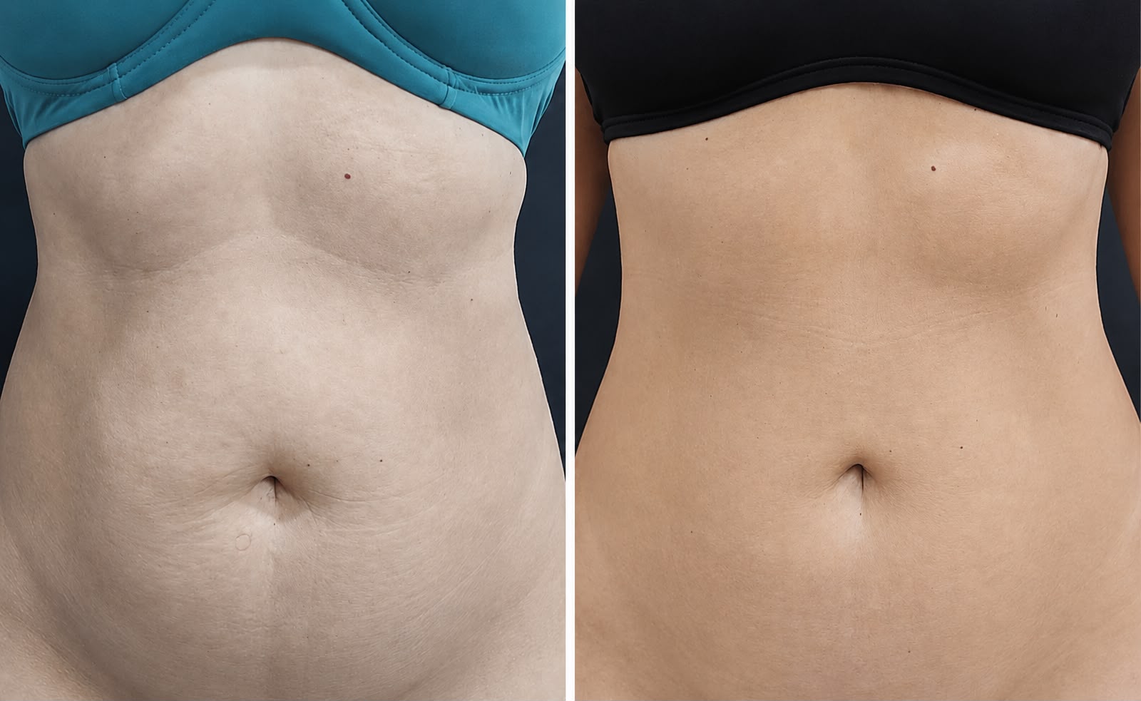 Procedimento de Lipo Enzimática na Clínica Mulher Estética