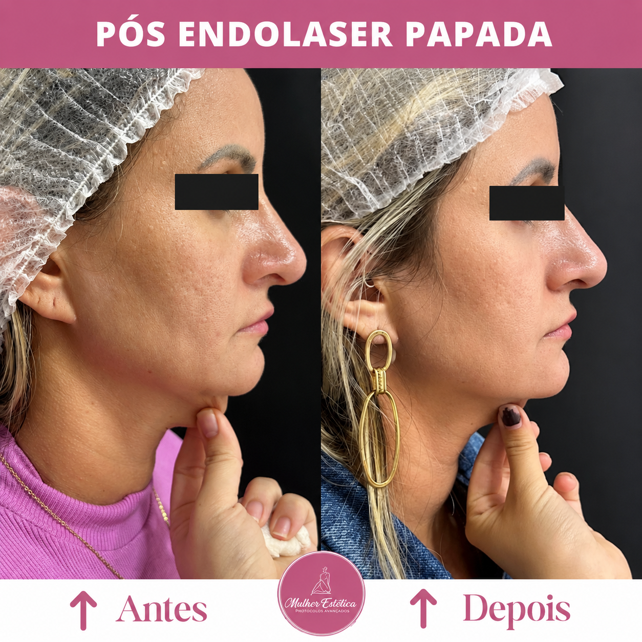 Lipo de papada para redução de gordura localizada e definição do contorno facial