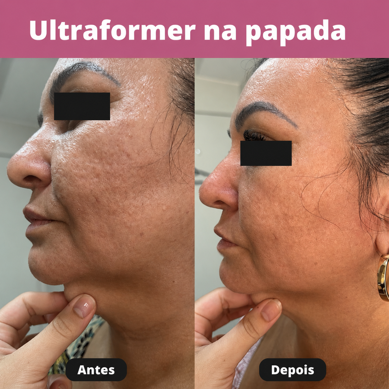 Aplicação personalizada de lipo enzimática na região da papada