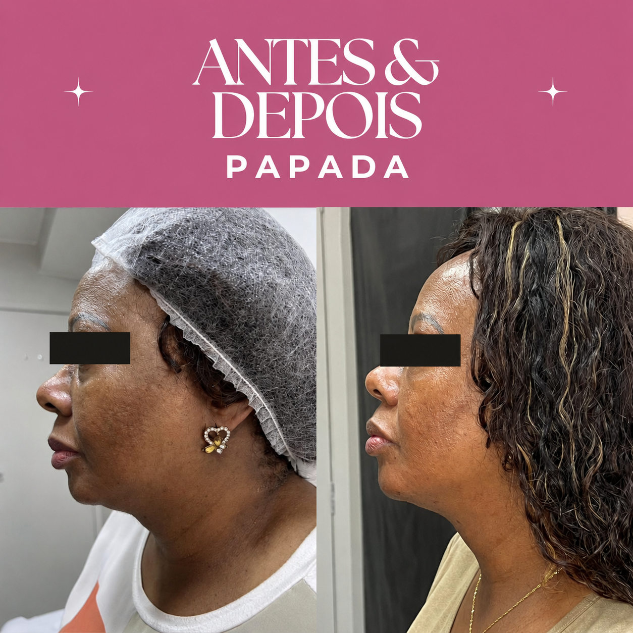 Avaliação personalizada para tratamento de lipo de papada