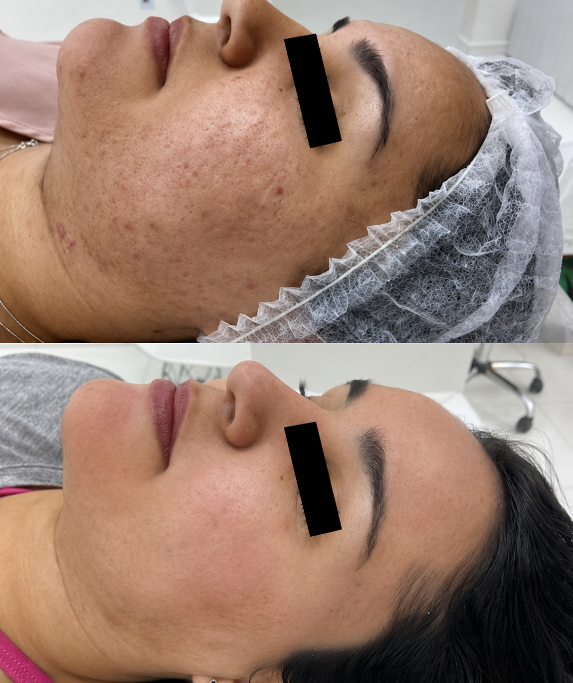 Antes e depois ilustrativo do tratamento com Peeling Químico
