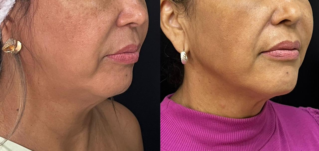 Preenchimento facial com ácido hialurônico para harmonização e rejuvenescimento