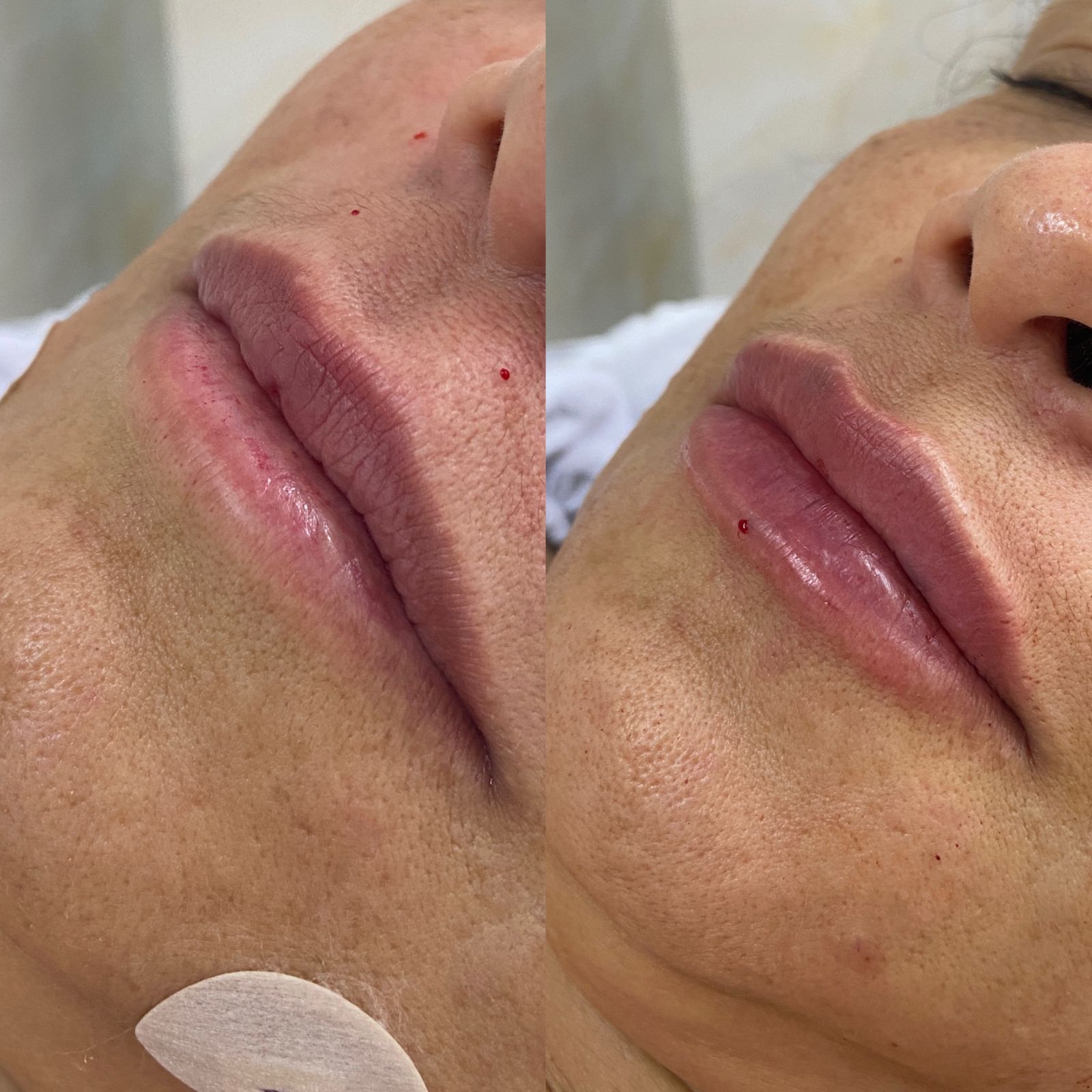 Preenchimento labial com ácido hialurônico para volume, contorno e hidratação