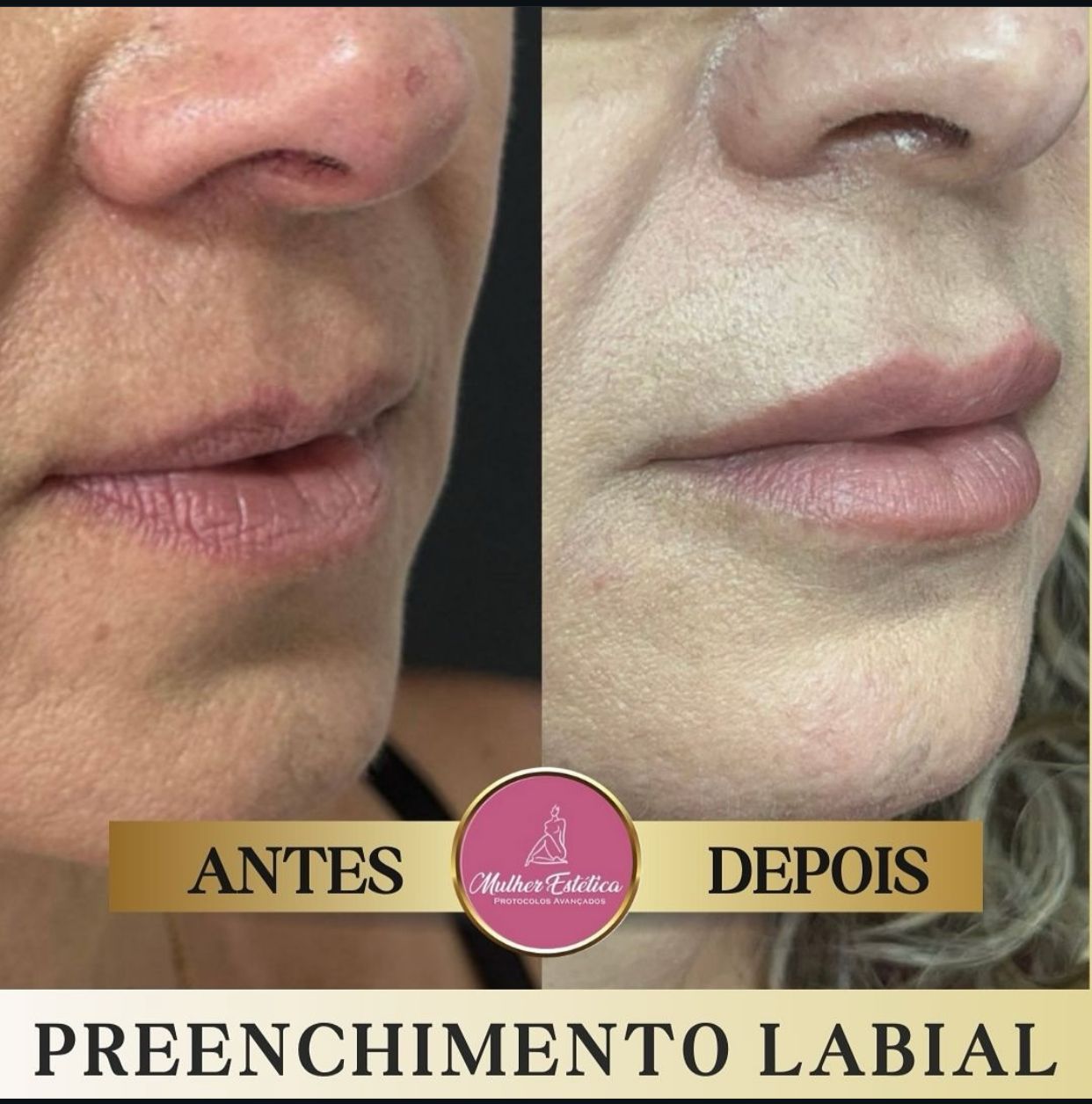 Antes e depois de preenchimento labial com resultado natural