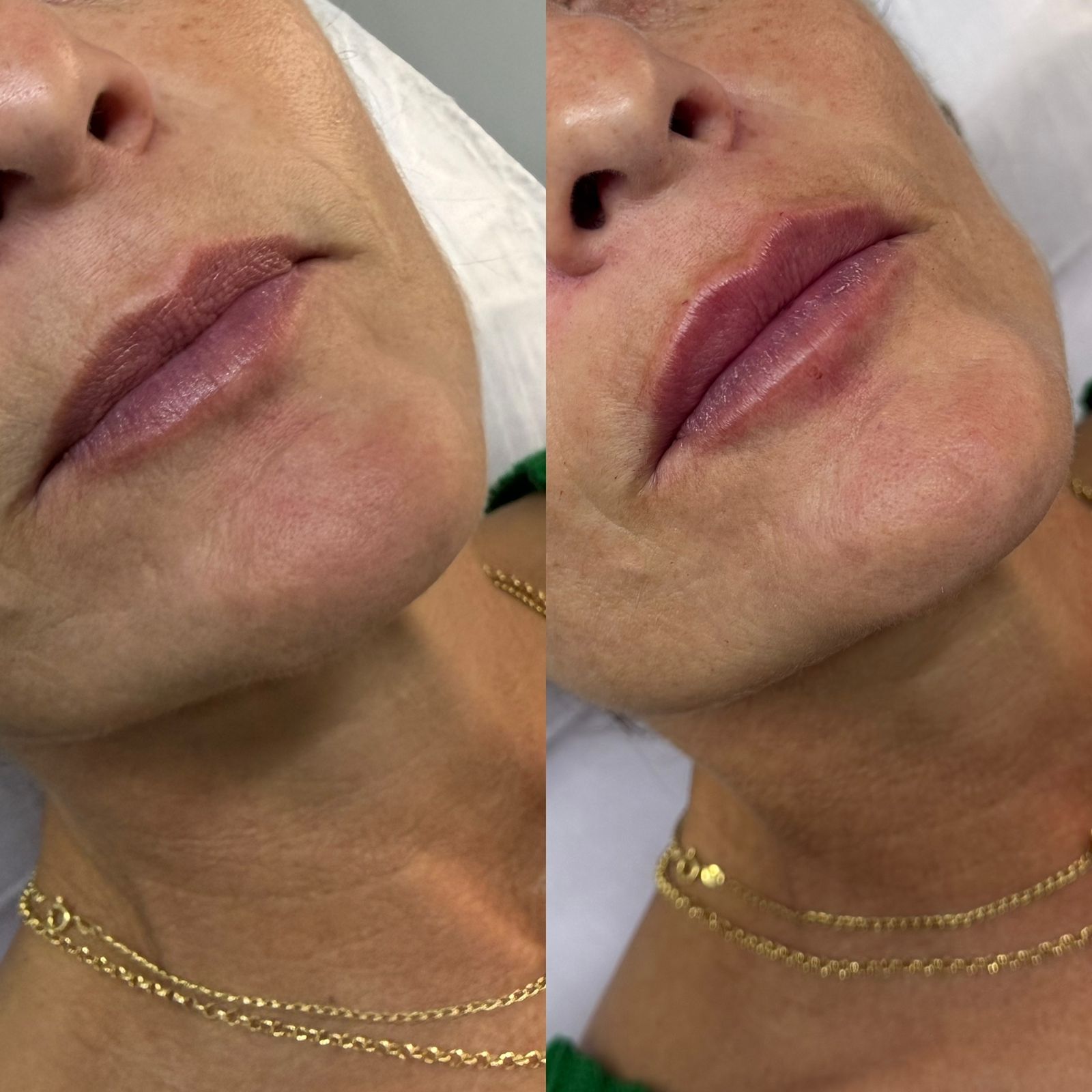 Acompanhamento e cuidados após o preenchimento labial