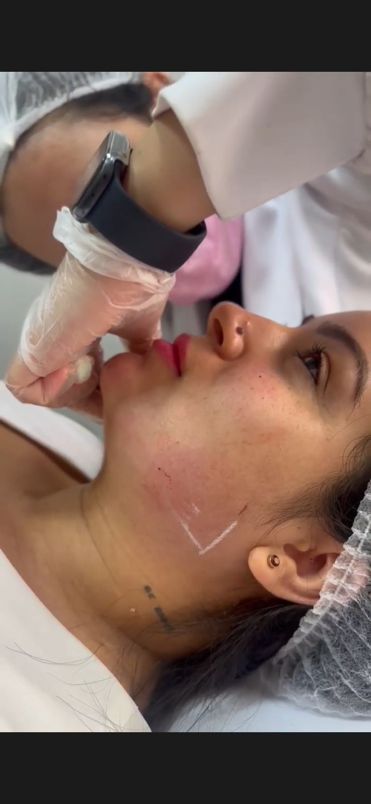Preenchimento de mandíbula para definição e equilíbrio do contorno facial