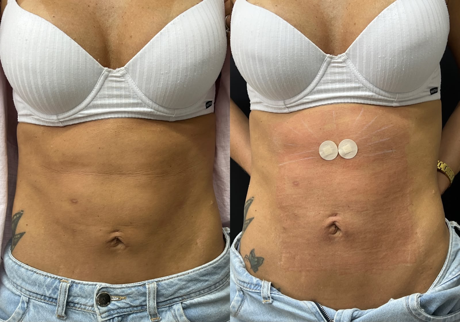 Imagem dupla mostrando tratamento corporal com Radiofrequência Microagulhada Robótica na região abdominal