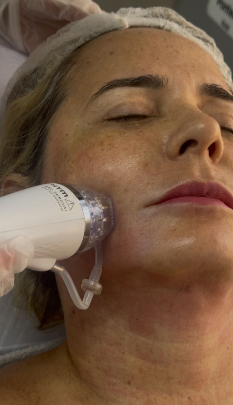 Radiofrequência Microagulhada Robótica aplicada em tratamento facial
