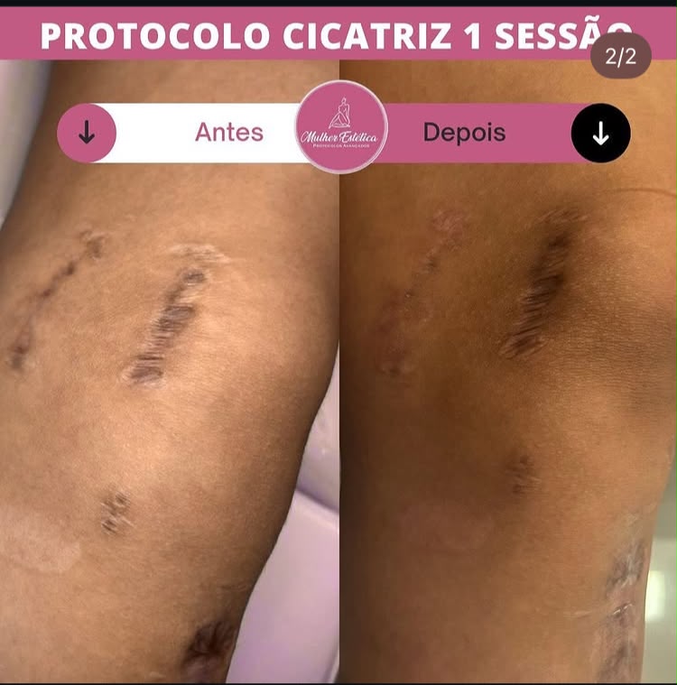 Resultado ilustrativo de tratamento estético para melhora da aparência de cicatrizes