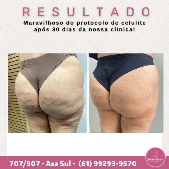 Resultado antes e depois do tratamento Celulite Zero