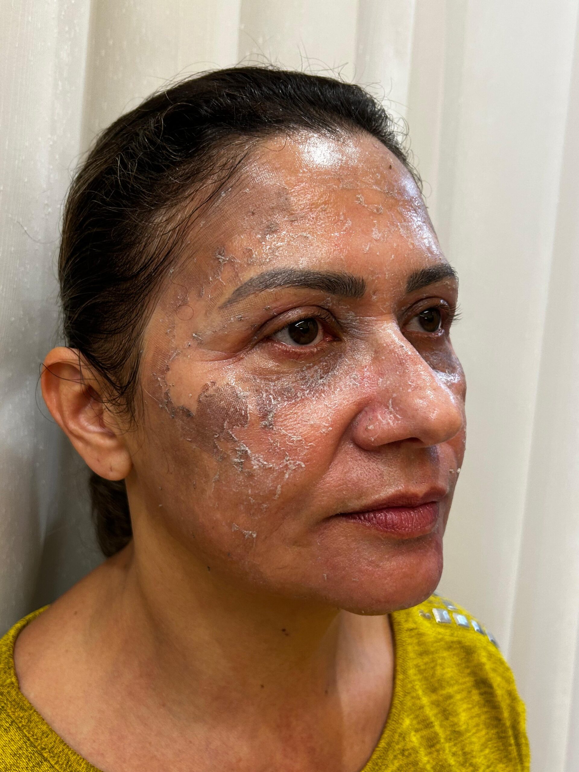Evolução da pele no quarto dia após o Laser de CO2 Fracionado