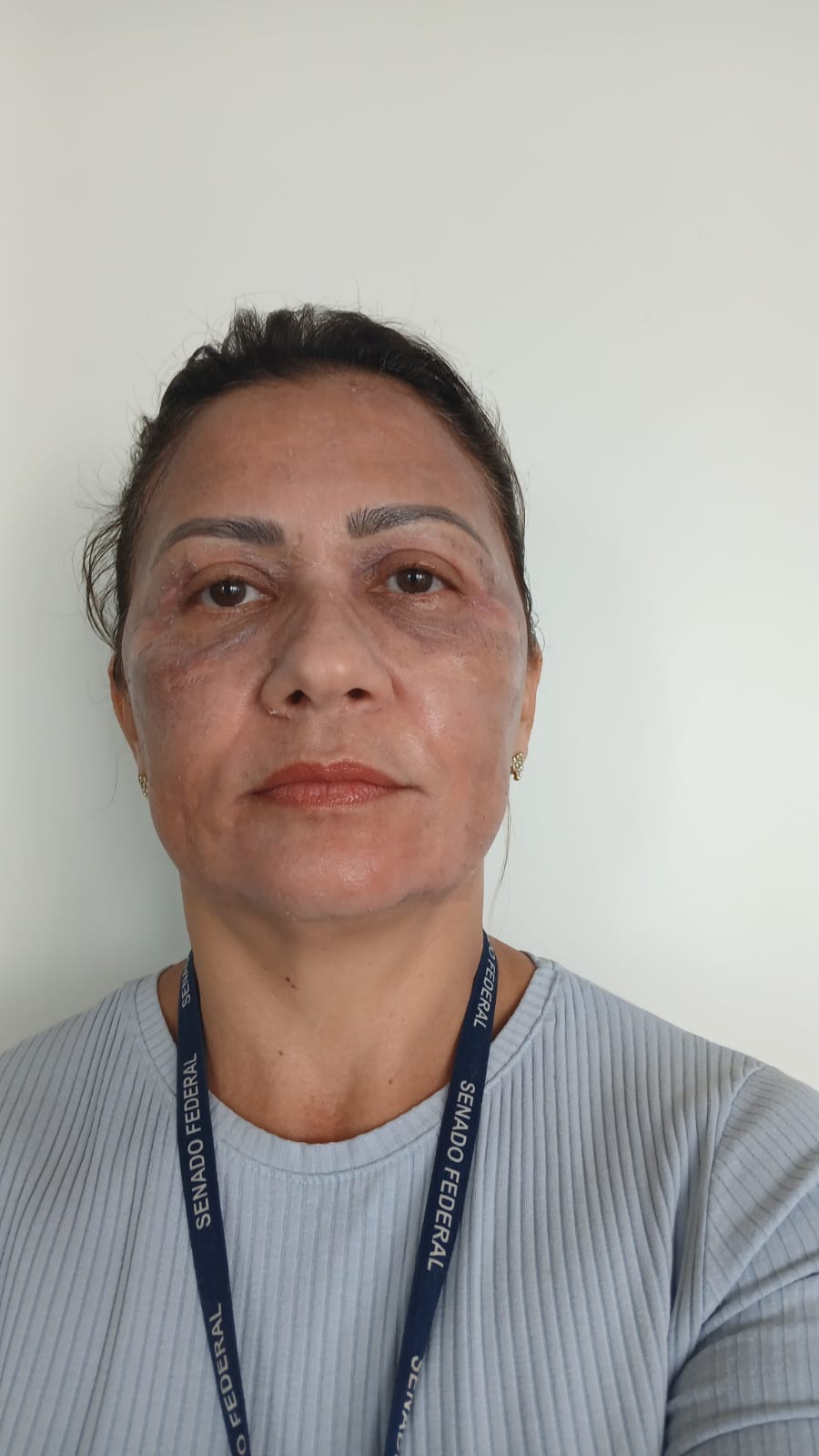 Evolução da pele no terceiro dia após o Laser de CO2 Fracionado