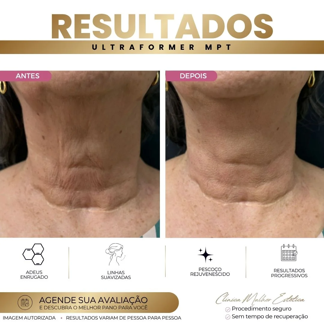 Antes e depois do Ultraformer MPT para flacidez no pescoço