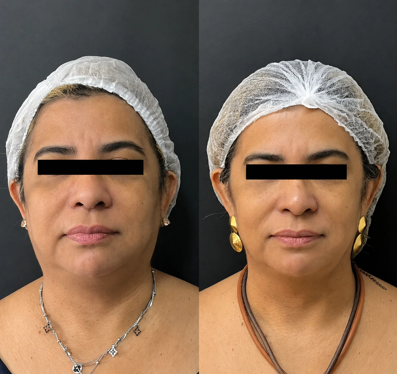 Antes e depois do rejuvenescimento facial com Ultraformer MPT
