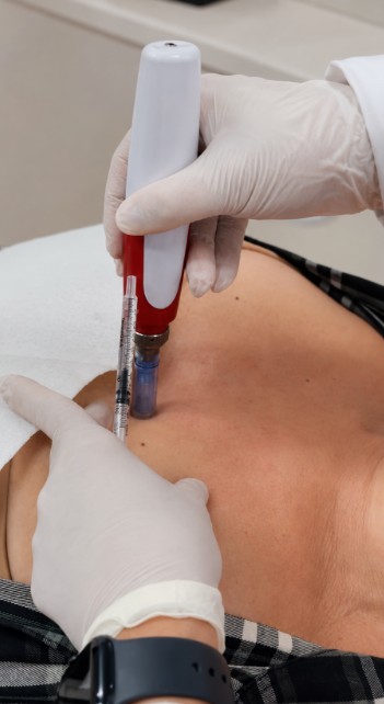 Aplicação facial do tratamento de Microagulhamento