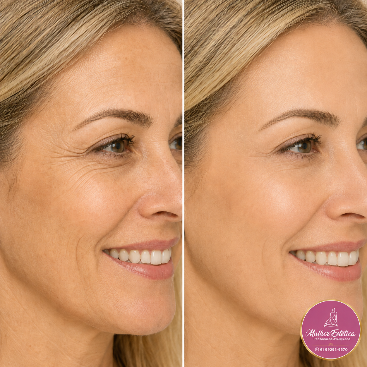 Aplicação de Toxina Botulínica na Clínica Mulher Estética