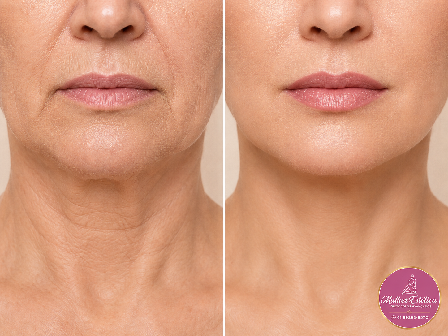 Toxina Botulínica na Clínica Mulher Estética