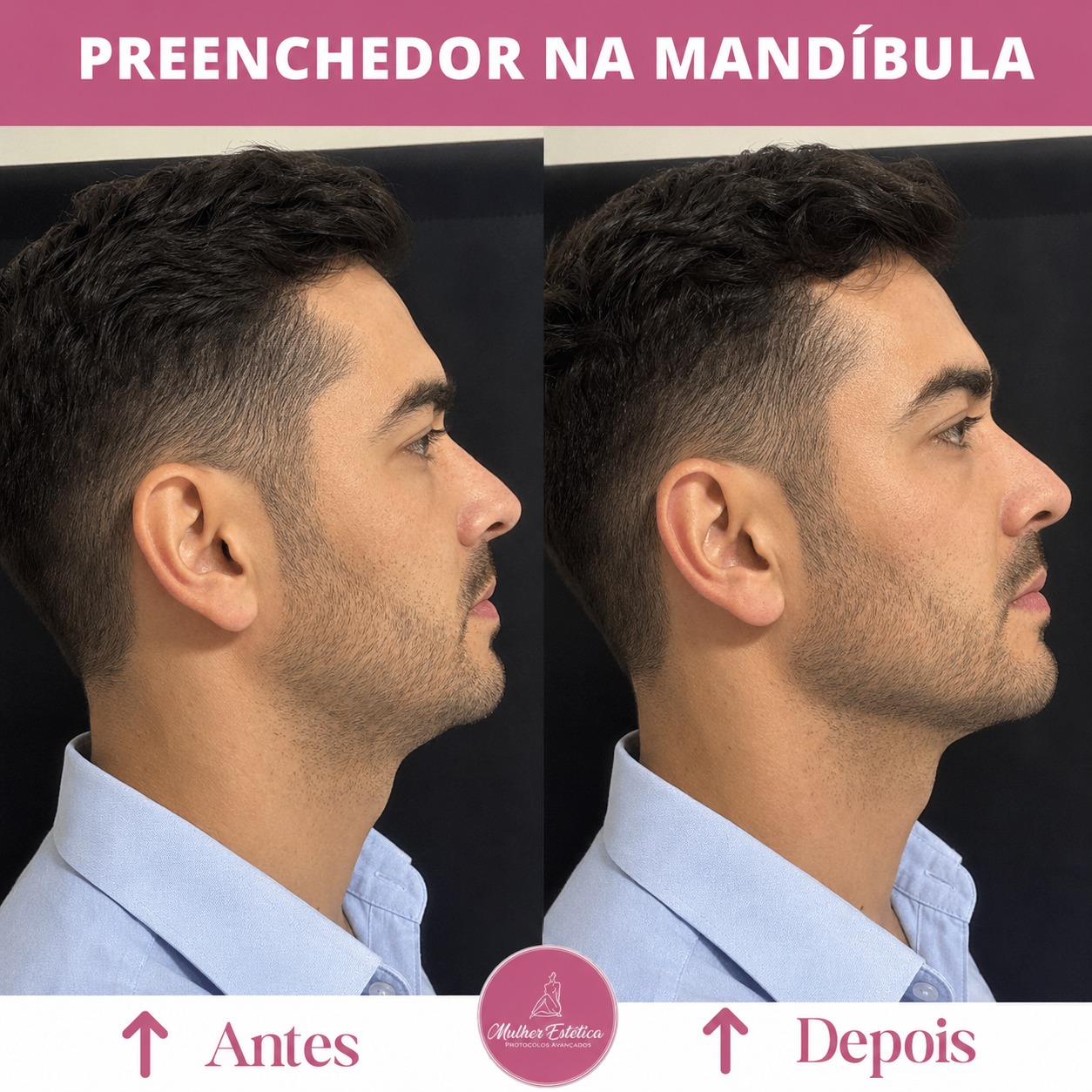 Preenchimento na mandíbula para definição do contorno facial