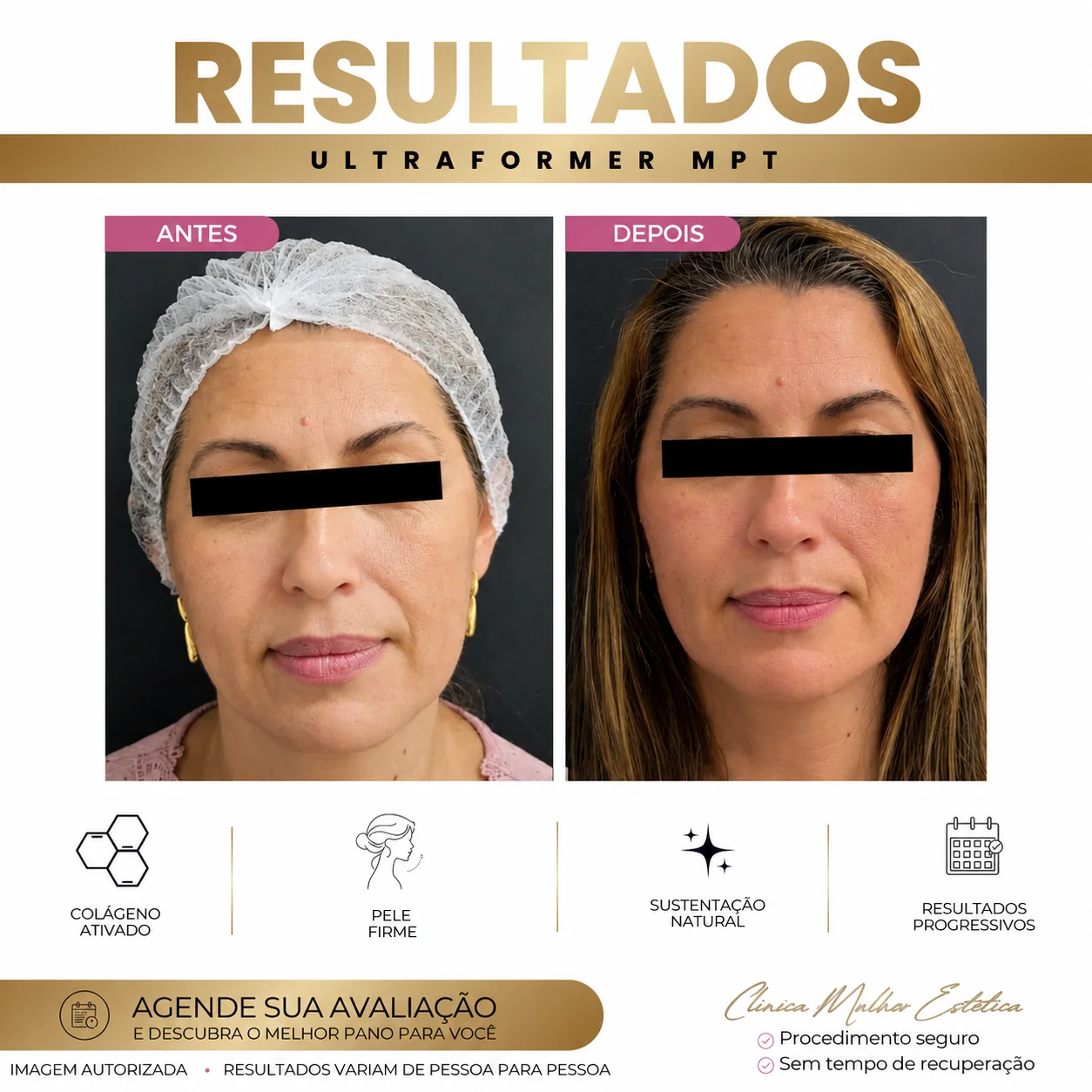 Resultado de rejuvenescimento facial com Ultraformer MPT na Clínica Mulher Estética